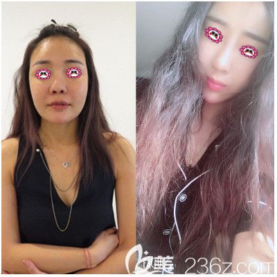 珠海仁爱整形隆鼻效果图 珠海仁爱整形隆鼻效果图