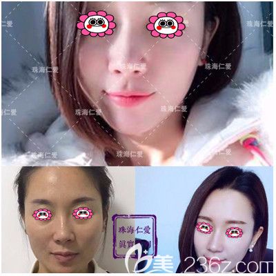 珠海仁爱瘦脸变化图 珠海仁爱瘦脸变化图