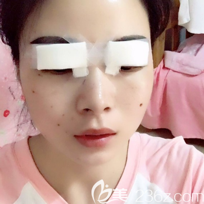 珠海仁爱双眼皮案例术后天效果图 珠海仁爱双眼皮案例术后天效果图