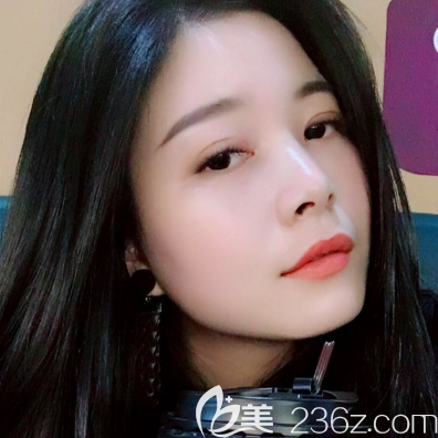 珠海仁爱肖新春医生双眼皮案例一个月自拍 珠海仁爱肖新春医生双眼皮案例一个月自拍