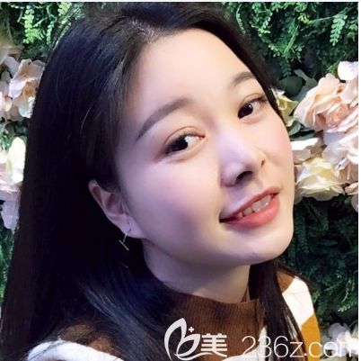 感觉自己单眼皮不好看于是去珠海仁爱找肖新春医生做了全切双眼皮手术