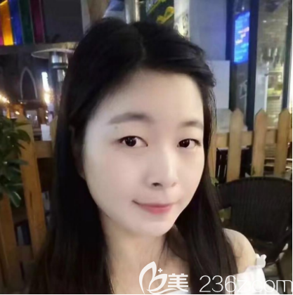 珠海仁爱双眼皮案例术前照片 珠海仁爱双眼皮案例术前照片