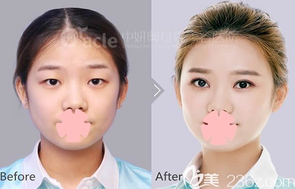 长春奥拉克陈继革院长眼综合+面部脂肪填充效果图