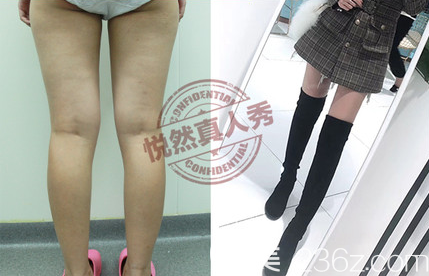 北京悦然医疗美容诊所X型腿矫正案例