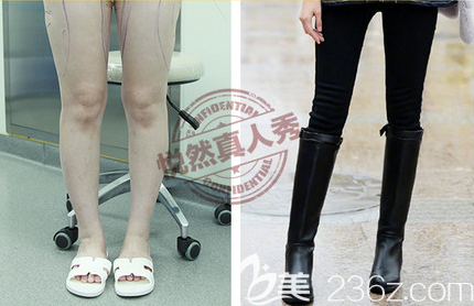 北京悦然医疗美容诊所XO型腿矫正案例