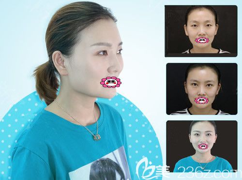 徐州时光洪扬整形曹洪扬院长双眼皮+开眼角变化图