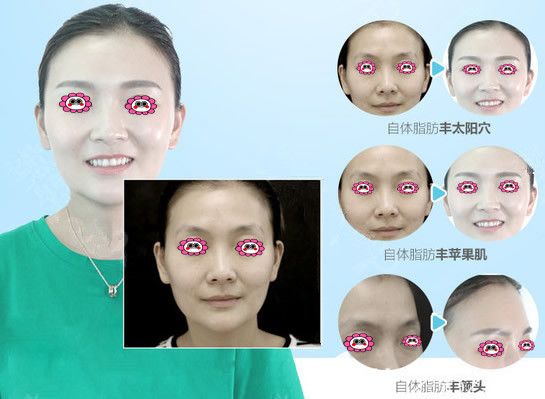 曹洪扬院长自体脂肪填充效果图