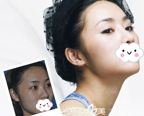 主任做假体隆鼻88天后恢复