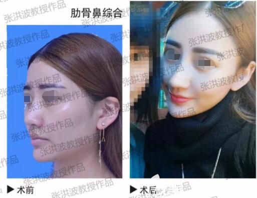 张洪波医生隆鼻前后对比案例
