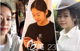 我在柳州华美整形做眼鼻部整形前的照片 我在柳州华美整形做眼鼻部整形前的照片