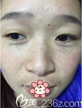 术前我的斑很多 术前我的斑很多