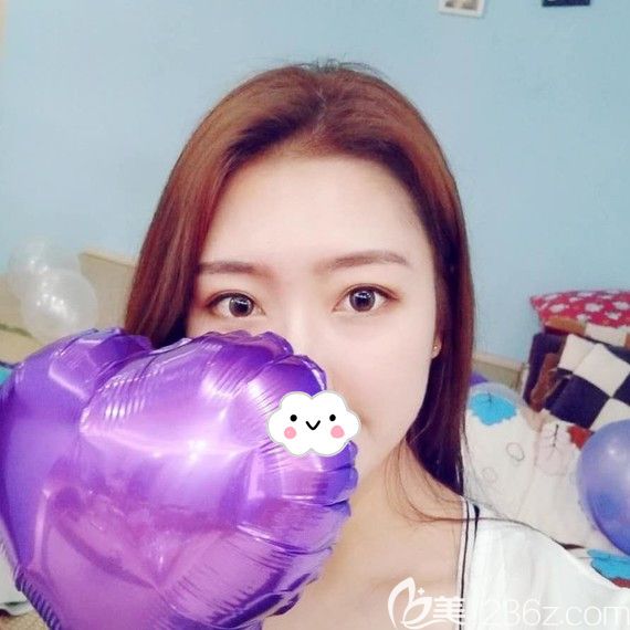 荆州华美李杰埋线双眼皮术后1月恢复照片