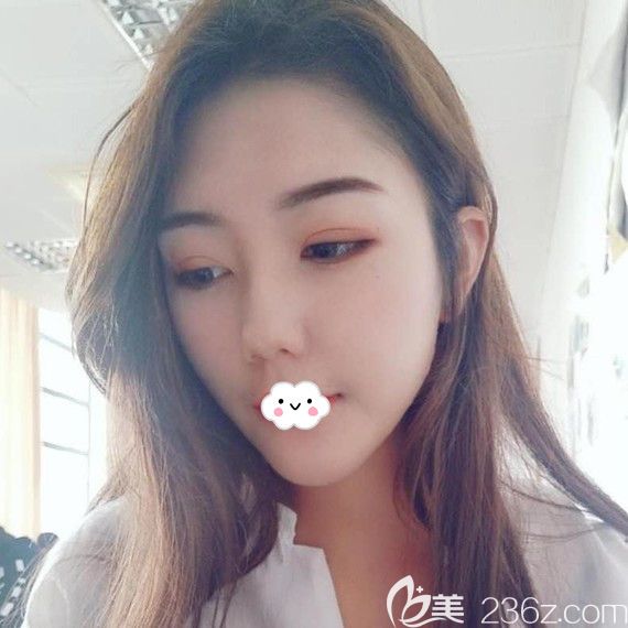 荆州华美李杰埋线双眼皮2个月恢复图