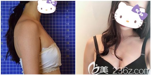 金辉院长做假体隆胸手术恢复效果 金辉院长做假体隆胸手术恢复效果