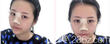 我在柳州华美做双眼皮和鼻综合术后第3天 我在柳州华美做双眼皮和鼻综合术后第3天