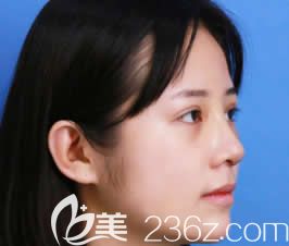 我在柳州华美做眼鼻部综合整形第7天 我在柳州华美做眼鼻部综合整形第7天