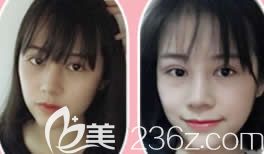 柳州做双眼皮哪里好?上传我在华美整形做7MM全切双眼皮+鼻综合隆鼻后28天恢复过程图