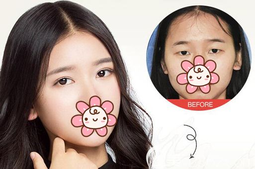 双眼皮整形125天后恢复效果 双眼皮整形125天后恢复效果