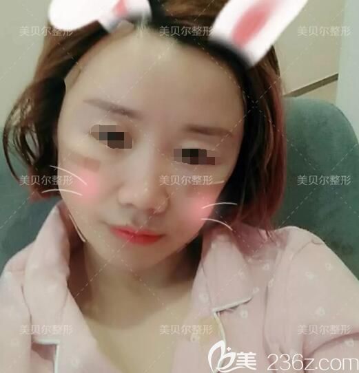 李志勇医生做脂肪填充术后天 李志勇医生做脂肪填充术后天