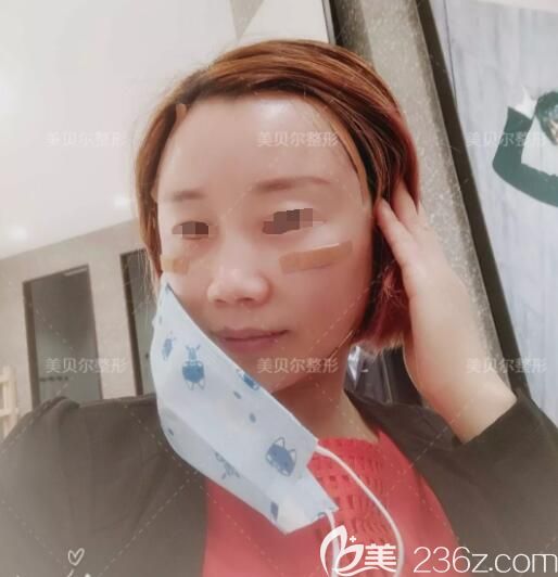 找苏州美贝尔医生做自体脂肪填充术后三天 找苏州美贝尔医生做自体脂肪填充术后三天