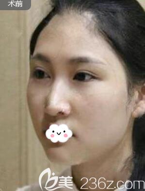 随州奥莱<!--<i data=20240703-sp></i>-->进口硅胶假体隆鼻真人案例 随州奥莱<!--<i data=20240703-sp></i>-->进口硅胶假体隆鼻真人案例