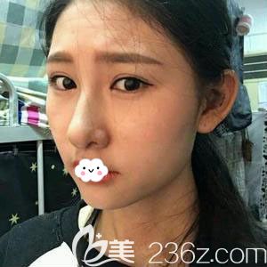 随州奥莱<!--<i data=20240703-sp></i>-->硅胶隆鼻术后恢复过程图 随州奥莱<!--<i data=20240703-sp></i>-->硅胶隆鼻术后恢复过程图