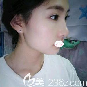 随州奥莱隆鼻整形效果怎么样?韩国进口三段式硅胶假体隆鼻术后恢复过程图