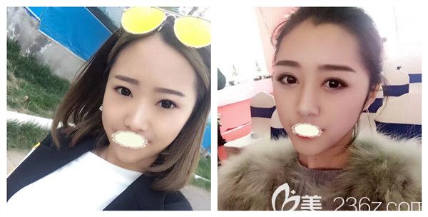 成都铜雀台徐敦医生全切双眼皮+开内眦赘皮术后对比照 成都铜雀台徐敦医生全切双眼皮+开内眦赘皮术后对比照