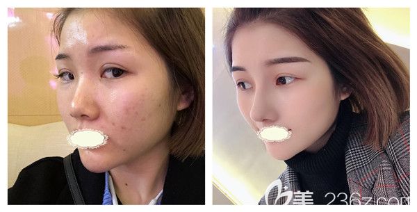 成都铜雀台周柯医生肋软骨假体隆鼻真实案例 成都铜雀台周柯医生肋软骨假体隆鼻真实案例