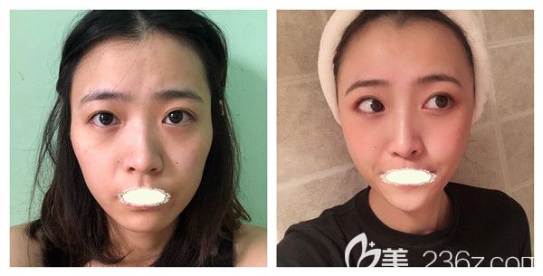 铜雀台雷刚主任自体脂肪全面部填充术后15天效果对比 铜雀台雷刚主任自体脂肪全面部填充术后15天效果对比