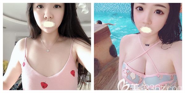 成都铜雀台雷刚医生假体隆胸术后真实案例对比效果展示 成都铜雀台雷刚医生假体隆胸术后真实案例对比效果展示