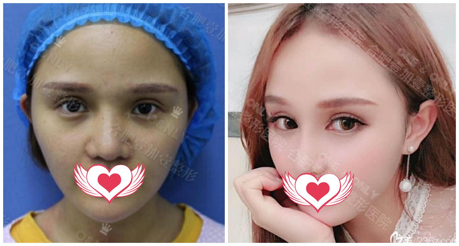 合肥壹加壹医院怎么样?壹加壹<!--<i data=20240703-sp></i>-->开外眼角案例效果一览 合肥壹加壹医院怎么样?壹加壹<!--<i data=20240703-sp></i>-->开外眼角案例效果一览