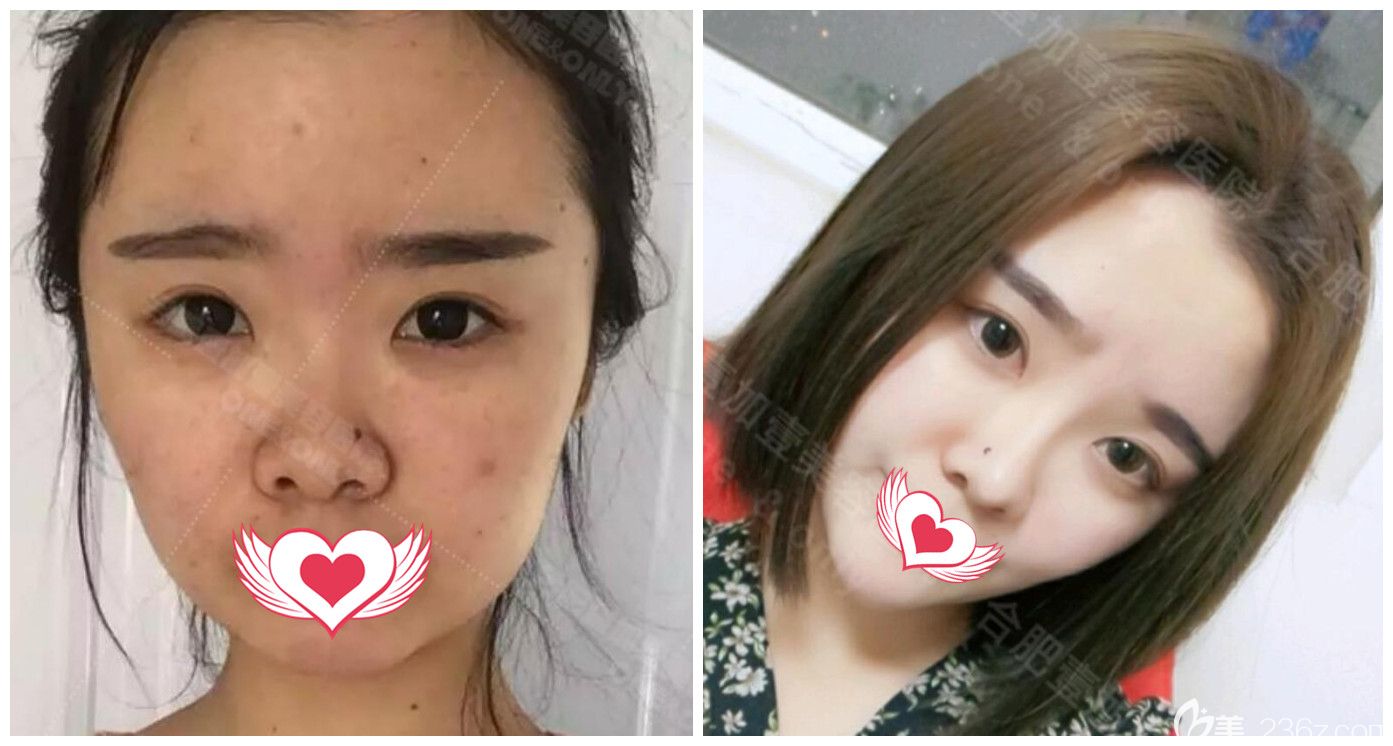 合肥壹加壹整形好吗?公布壹加壹<!--<i data=20240703-sp></i>-->鼻综合+膨体隆下巴真人案例 合肥壹加壹整形好吗?公布壹加壹<!--<i data=20240703-sp></i>-->鼻综合+膨体隆下巴真人案例