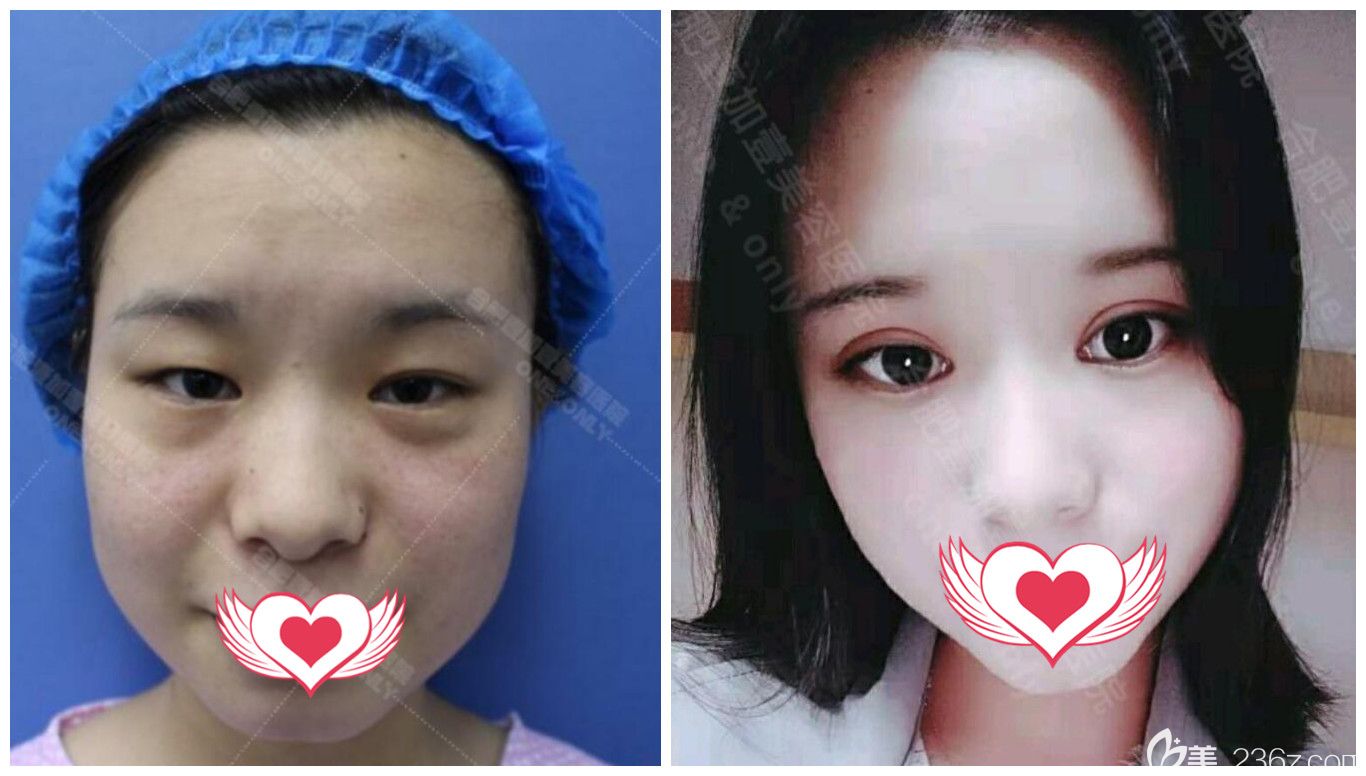 合肥壹加壹整形可以吗?来看壹加壹高影眼综合整形案例效果对比 合肥壹加壹整形可以吗?来看壹加壹高影眼综合整形案例效果对比