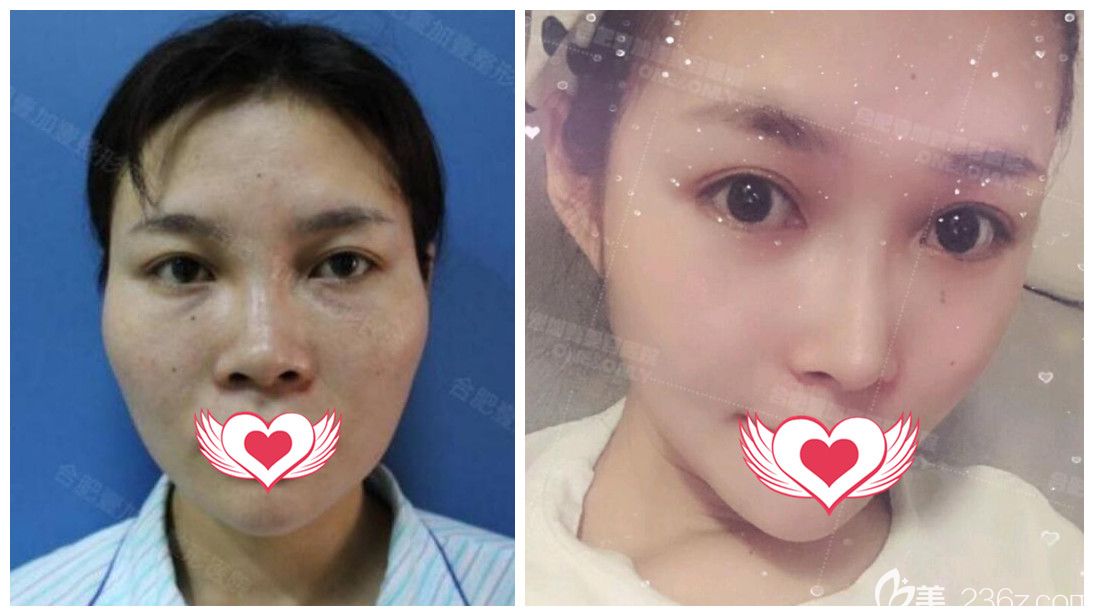 壹加壹甘泉涌隆鼻失败修复+自体脂肪全脸填充案例 壹加壹甘泉涌隆鼻失败修复+自体脂肪全脸填充案例