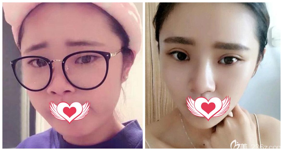 合肥壹加壹孟松双眼皮好吗?孟松双眼皮案例效果图来验证 合肥壹加壹孟松双眼皮好吗?孟松双眼皮案例效果图来验证