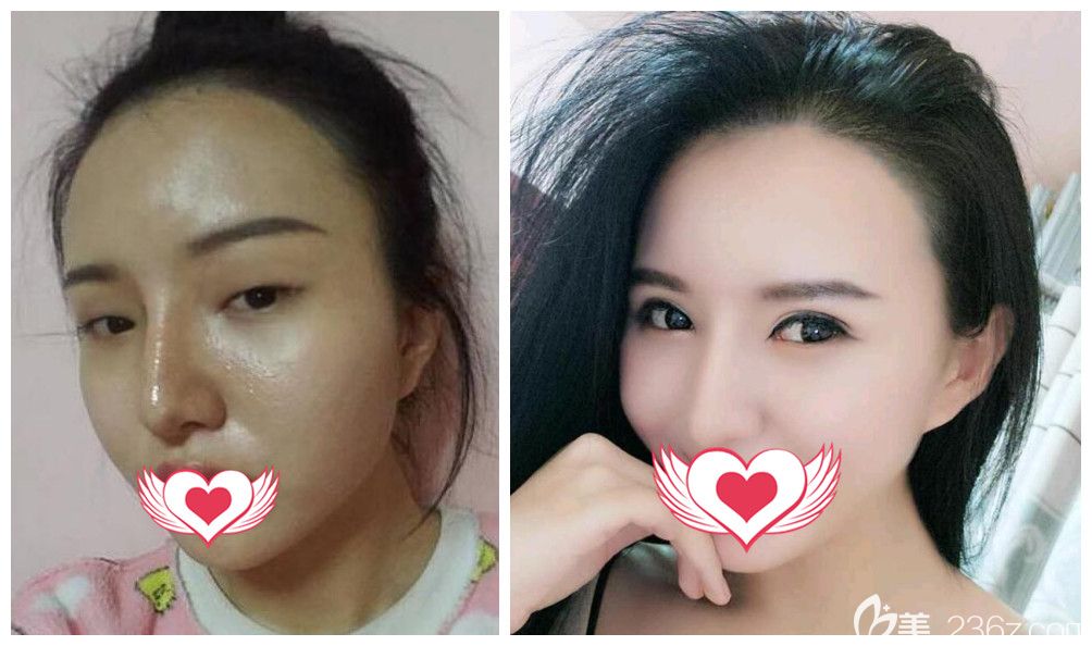 合肥壹加壹正规吗?壹加壹甘泉涌玖度美眼眼综合案例证明实力 合肥壹加壹正规吗?壹加壹甘泉涌玖度美眼眼综合案例证明实力