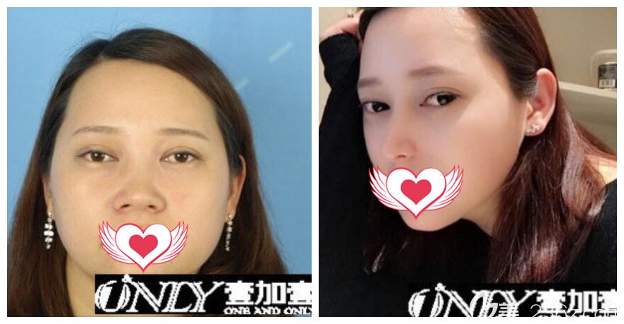 壹加壹孟松怎么样?展示合肥壹加壹孟松肋软骨鼻综合隆鼻案例效果 壹加壹孟松怎么样?展示合肥壹加壹孟松肋软骨鼻综合隆鼻案例效果
