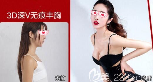 沈阳百嘉丽整形医院3D深V无痕丰胸真人前后效果对比