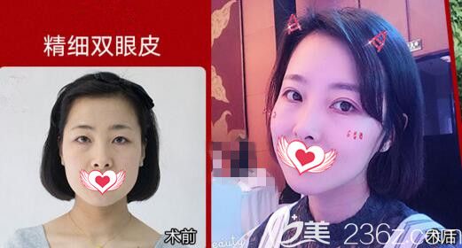 沈阳百嘉丽整形美容医院精细双眼皮真人案例