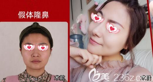 沈阳百嘉丽假体隆鼻真人前后效果对比