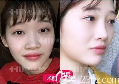 做鼻整形术前照 做鼻整形术前照
