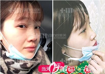 鼻整形术后3天样子 鼻整形术后3天样子