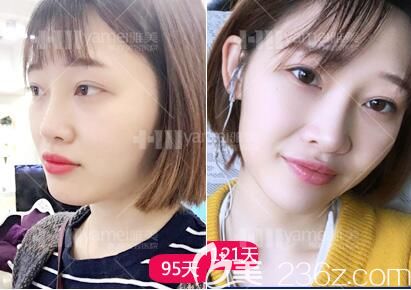 在长沙雅美做完鼻整形术后3个月后恢复效果情况 在长沙雅美做完鼻整形术后3个月后恢复效果情况