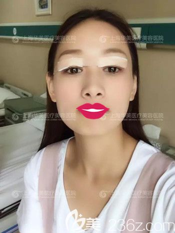 上海华美医疗美容医院杨亚益全切双眼皮+玻尿酸垫下巴真人案例术后第四天