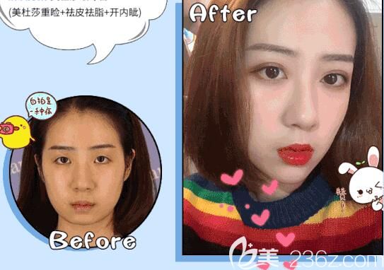 徐国建院长做切开双眼皮术后150天恢复效果