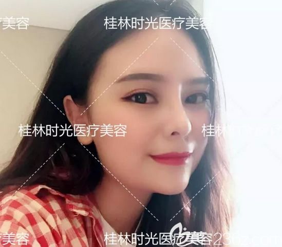 实拍:我在桂林时光整形做膨体+肋软骨鼻综合隆鼻及假体隆下巴真实恢复期图片