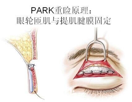 PARK法双眼皮手术原理