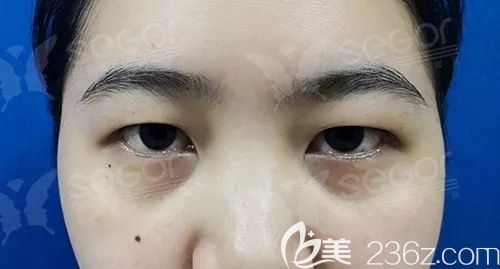 面诊常州曙光术前两边眼睛不对称,大小眼 面诊常州曙光术前两边眼睛不对称,大小眼