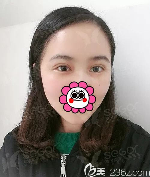 常州曙光分享做PARK法双眼皮术后四天恢复 常州曙光分享做PARK法双眼皮术后四天恢复